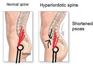 Iliopsoas 4